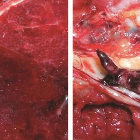 Covid-19 : ce que les autopsies nous apprennent sur les caillots sanguins et embolies pulmonaires